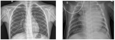 Pneumonia detection by binary classification: classical, quantum, and hybrid approaches for support vector machine (SVM)